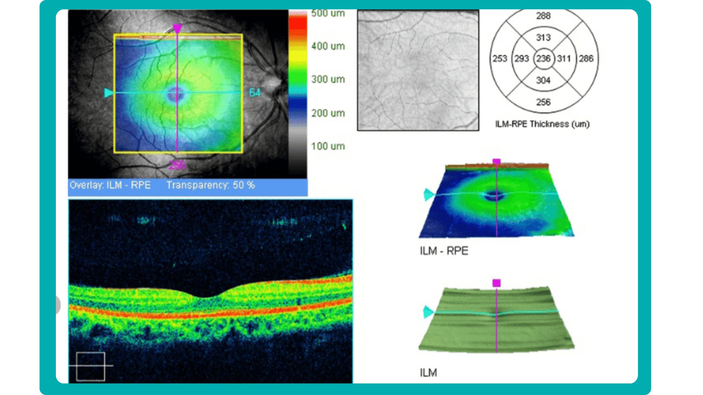 OCT scan and fundus image on an example of OCR report