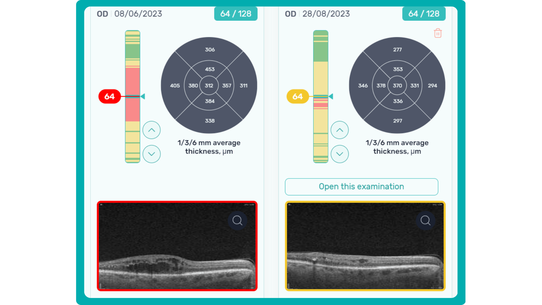 Thickness comparison, part of ALtris AI customisable OCT reports