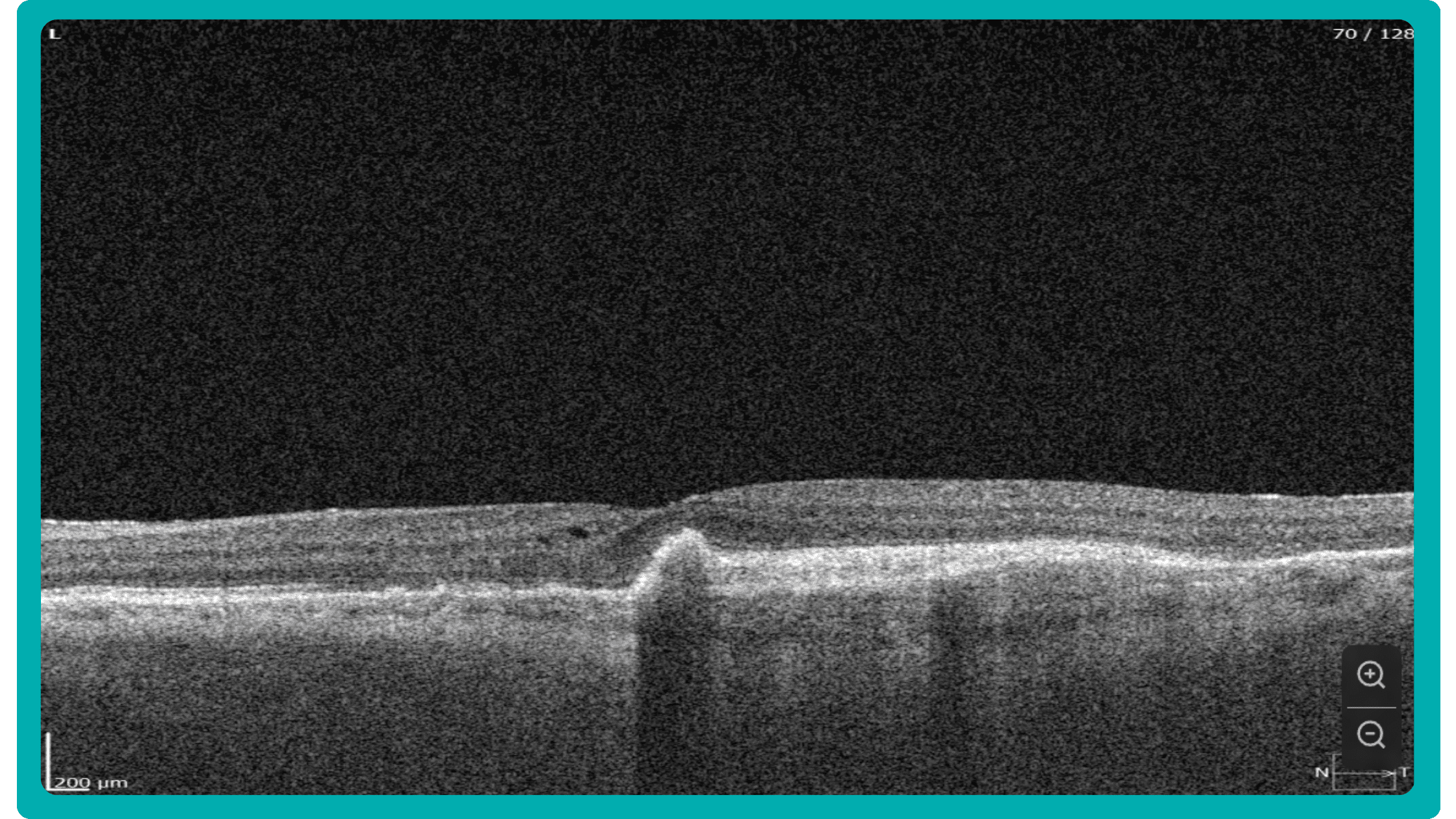 Wet AMD on OCT, example provided by Altris AI platform