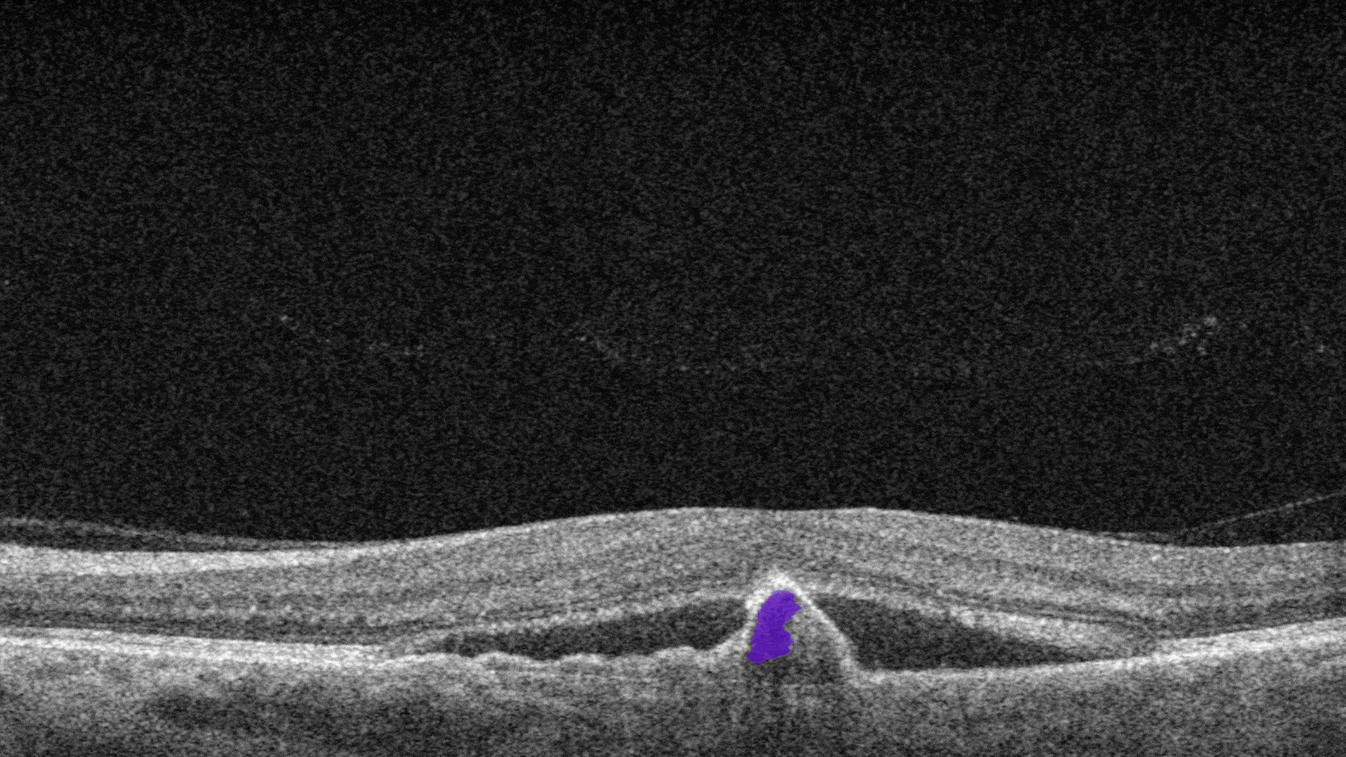 OCT Optometry: AI for OCT detection of Fibrovascular RPE detachment