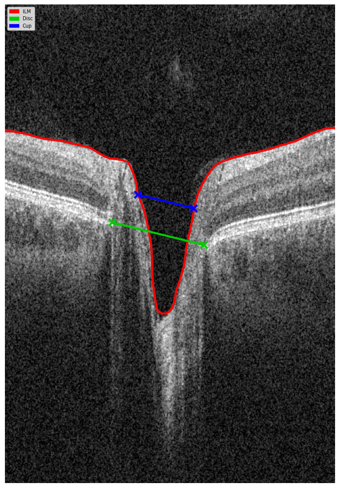 3d wide glaucoma report