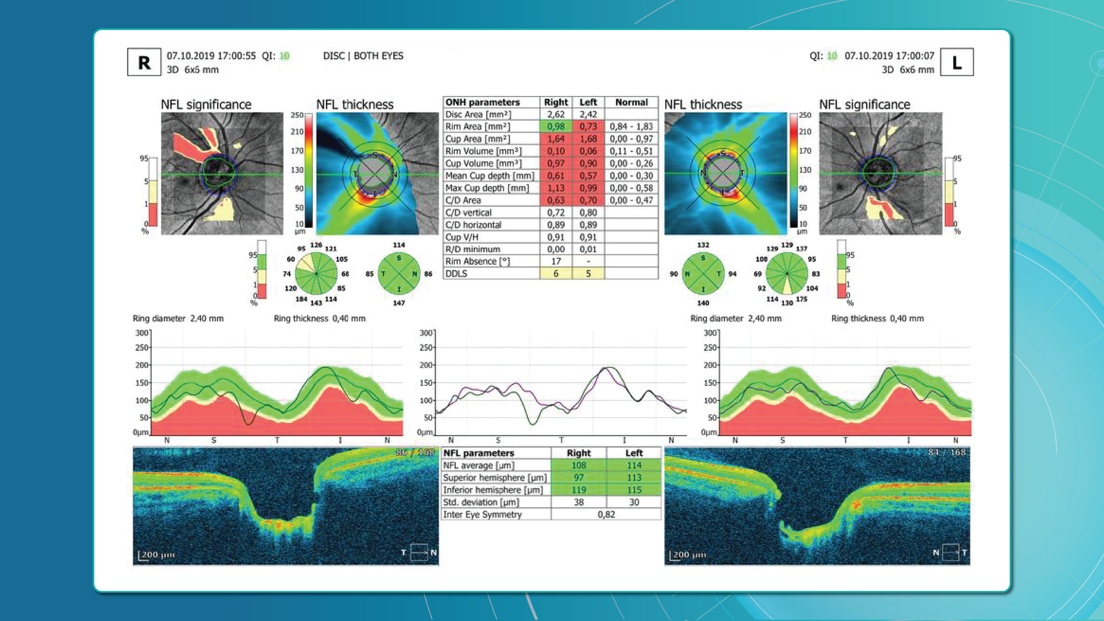Evaluating the optic nerve head (ONH)