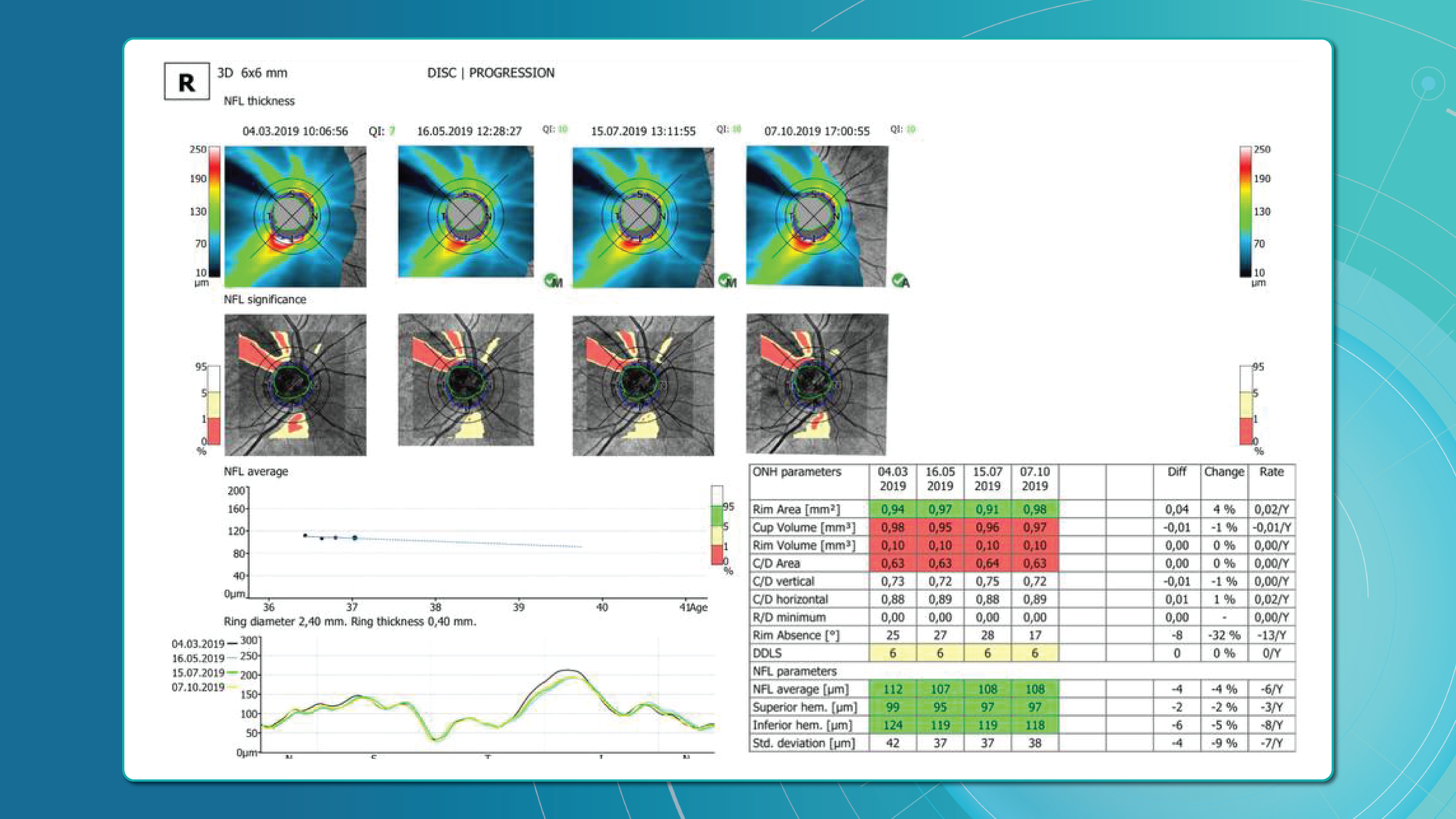 Visual glaucoma OCT analysis