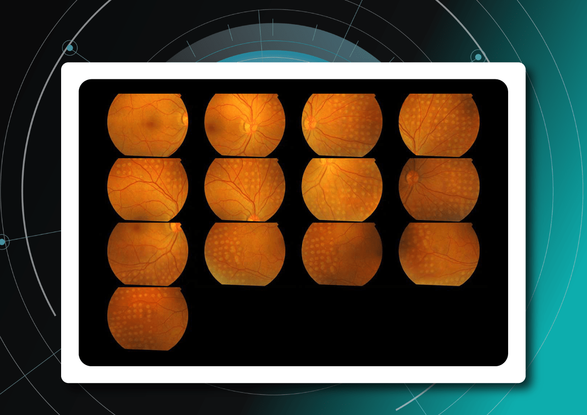 Diabetic retinopathy screening with fundus