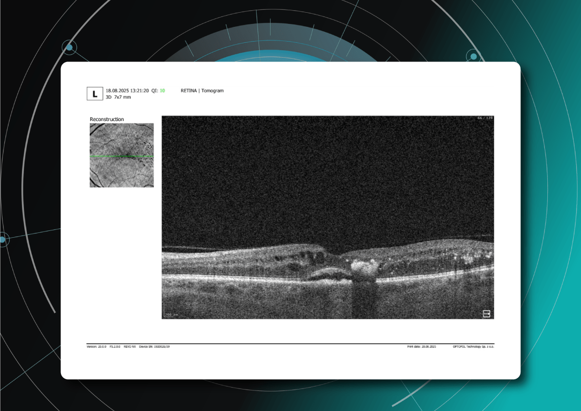 Example of diabetic retinopathy screening OCT