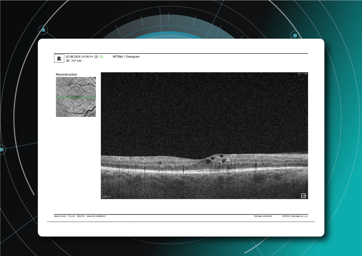 Diabetic retinopathy screening OCT